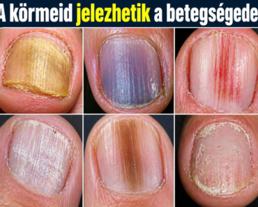 A körmeid jelezhetik a betegségedet!