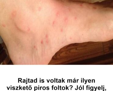 Viszkető, piros foltok jelentek meg rajtad? Ezt jobb, ha minél előbb tudod!