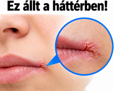 Neked is kirepedt már a szád sarka? – Több minden is állhat a háttérben, mint gondolnád